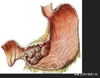 胃癌"帮凶"是哪些食物？如何科学饮食才能养胃？