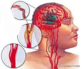 如何预防缺血性脑血管病？